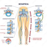 Sciatica stretches nerve stretching sciatic rid tikkaykhan grepmed