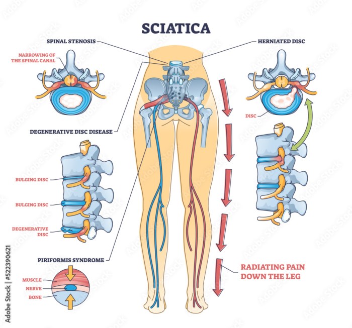 Sciatica stretches nerve stretching sciatic rid tikkaykhan grepmed
