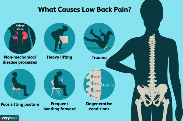Sciatica and back pain